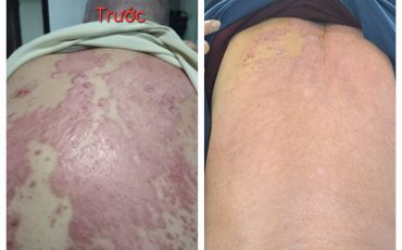 Câu chuyện hồi sinh làn da sau 15 năm bị vảy nến nhờ dinh dưỡng Nutrilite