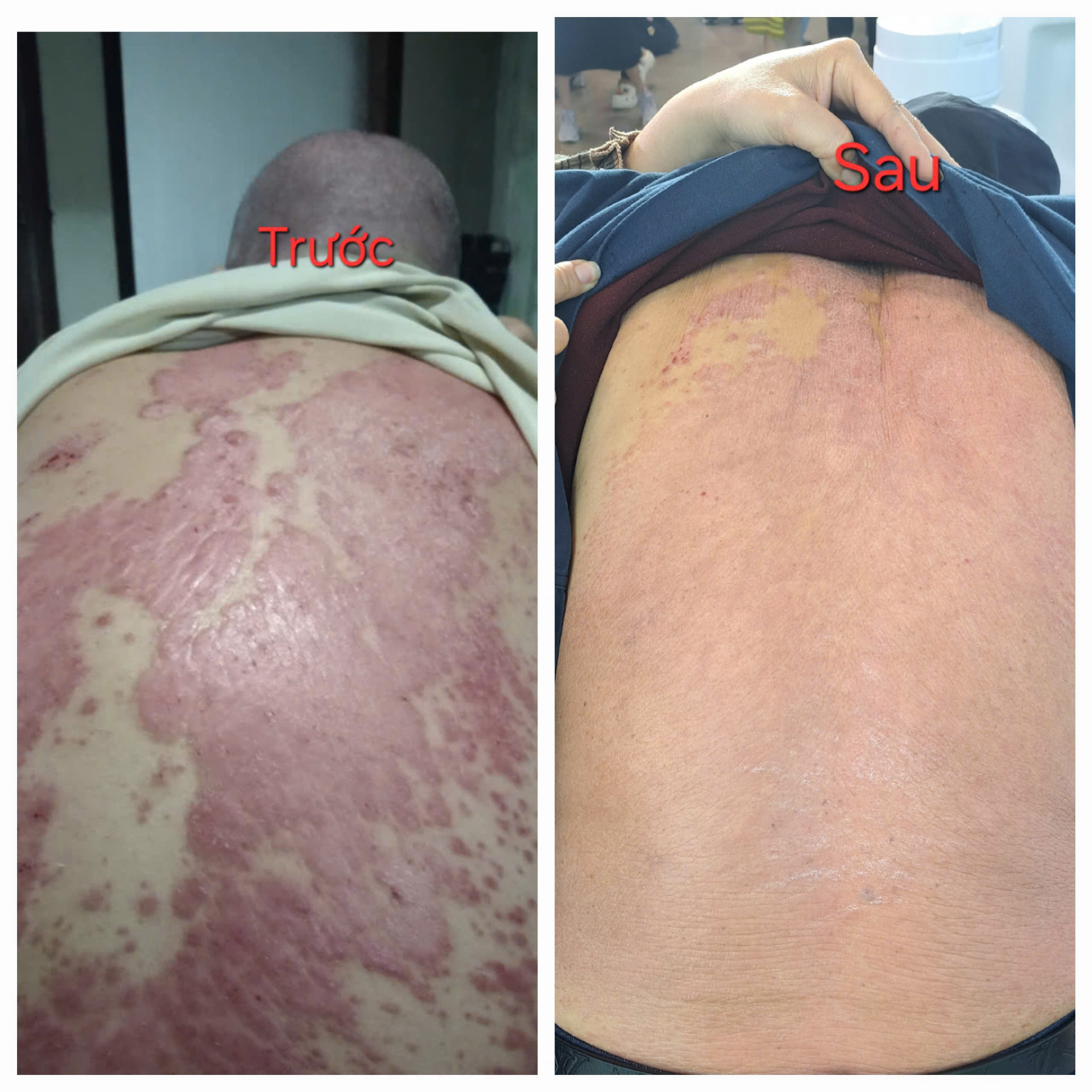 Câu chuyện hồi sinh làn da sau 15 năm bị vảy nến nhờ dinh dưỡng Nutrilite